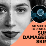 Stem Cells to Restore Sun Damaged Skin